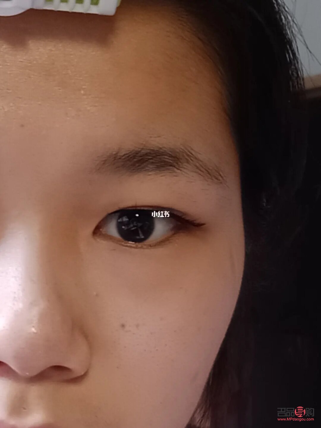 <h3>解决单眼皮肿眼泡的有效方法</h3>