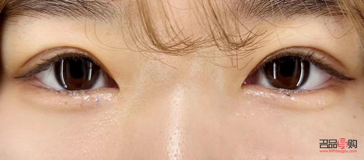 <h3>肿眼泡埋线双眼皮效果能持续多久？</h3>