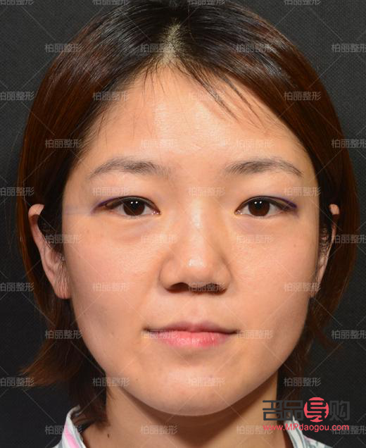 <h3>肿眼泡埋线双眼皮效果能持续多久？</h3>