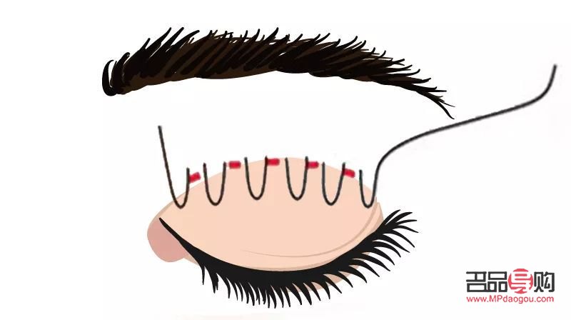 <h3>肿眼泡埋线双眼皮效果能持续多久？</h3>