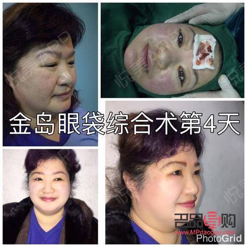 <h3>眼袋问题：非手术解决方案探讨</h3>