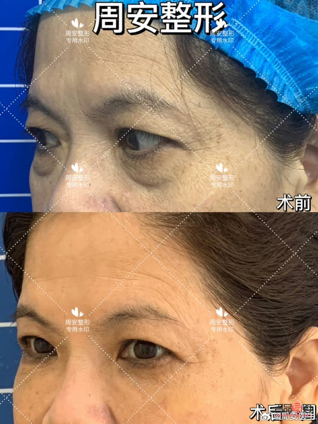 <h3>眼袋问题：非手术解决方案探讨</h3>