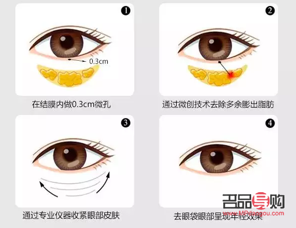 <h3>眼袋问题：非手术解决方案探讨</h3>