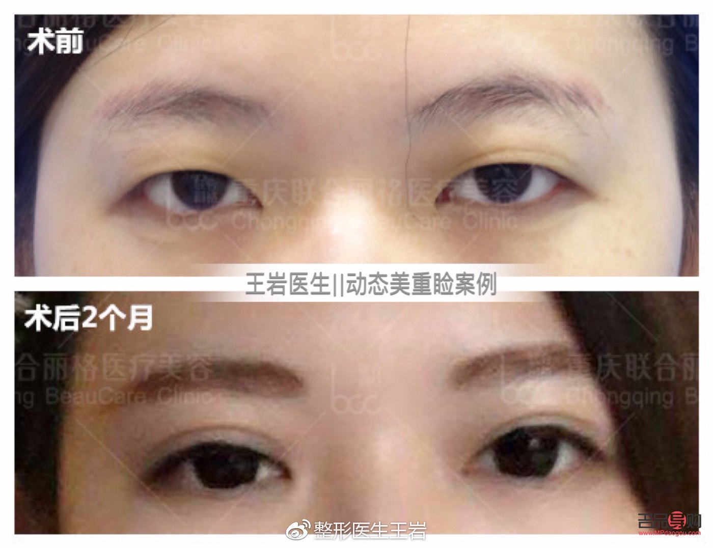 <h3>肿眼泡与非肿眼泡：眼部状态对比与解析</h3>