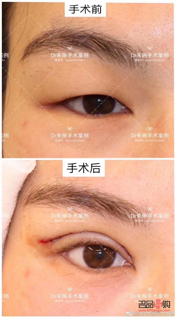 <h3>肿眼泡与非肿眼泡：眼部状态对比与解析</h3>