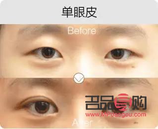 <h3>欧式大宽双眼皮：魅力之眼的新风尚</h3>