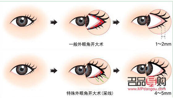 开外眼角手术过程图(开外眼角手术过程图片)
