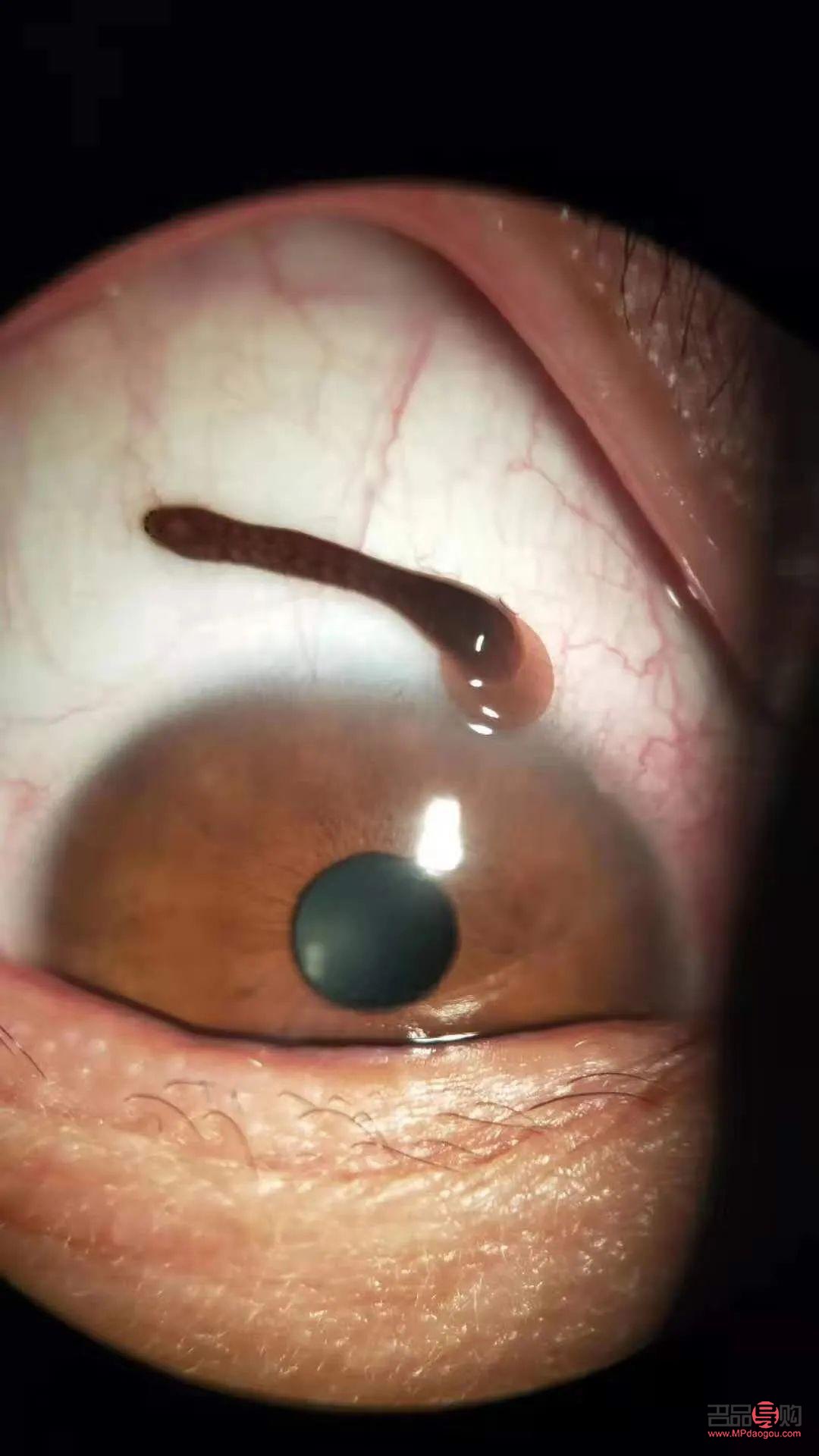 <h3>眼睛异物能否自行排出？</h3>