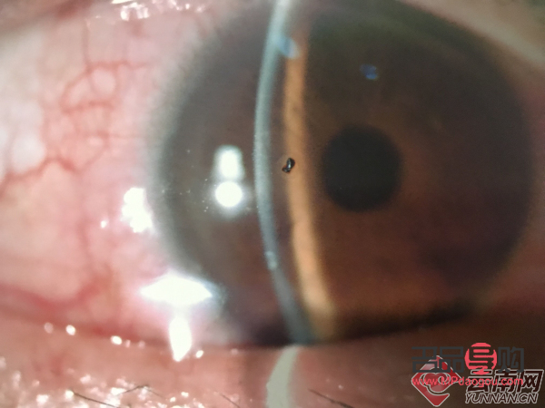 <h3>眼睛异物能否自行排出？</h3>