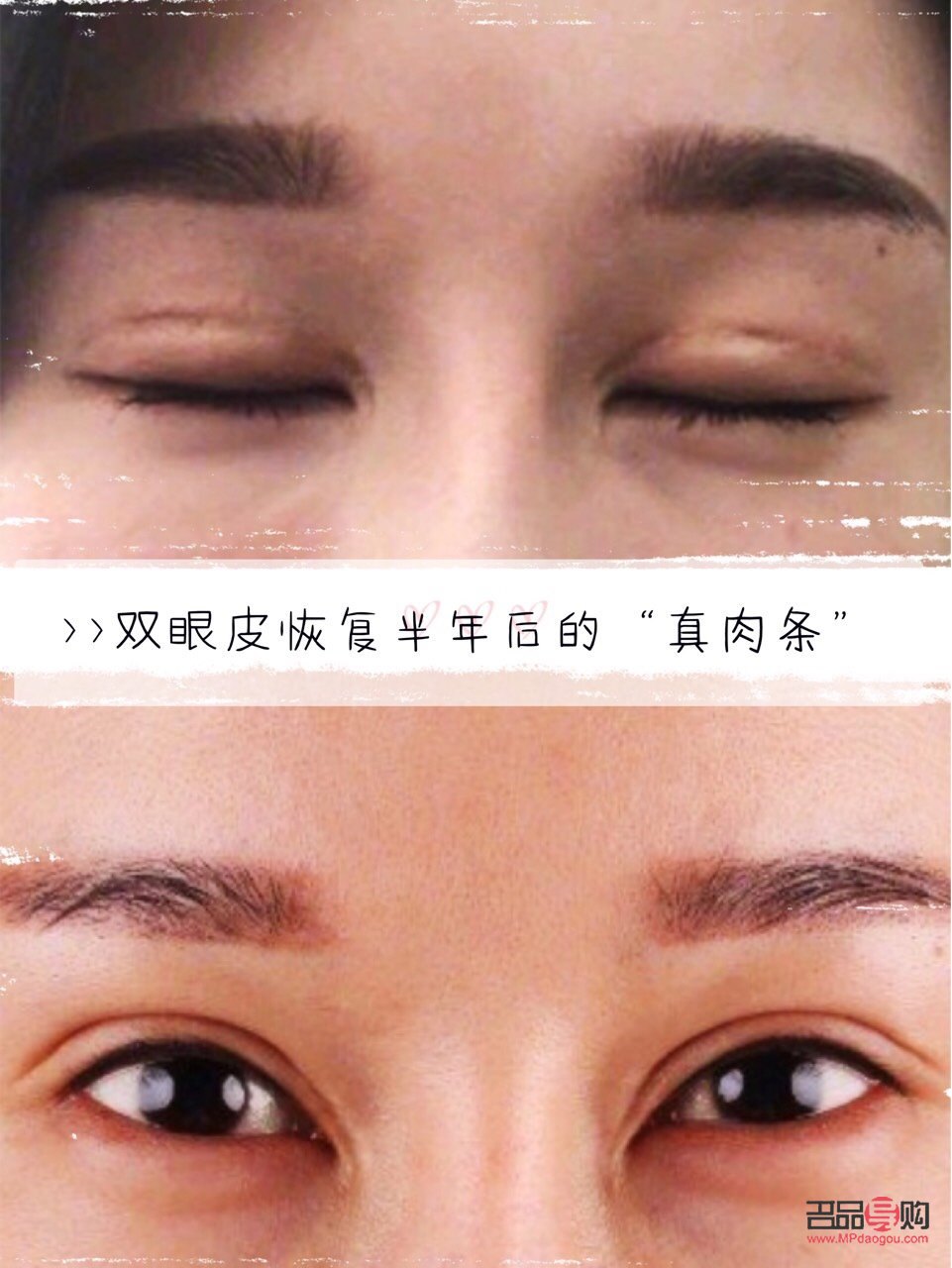 双眼皮肉条感怎么修复(双眼皮有肉条感怎么修复)