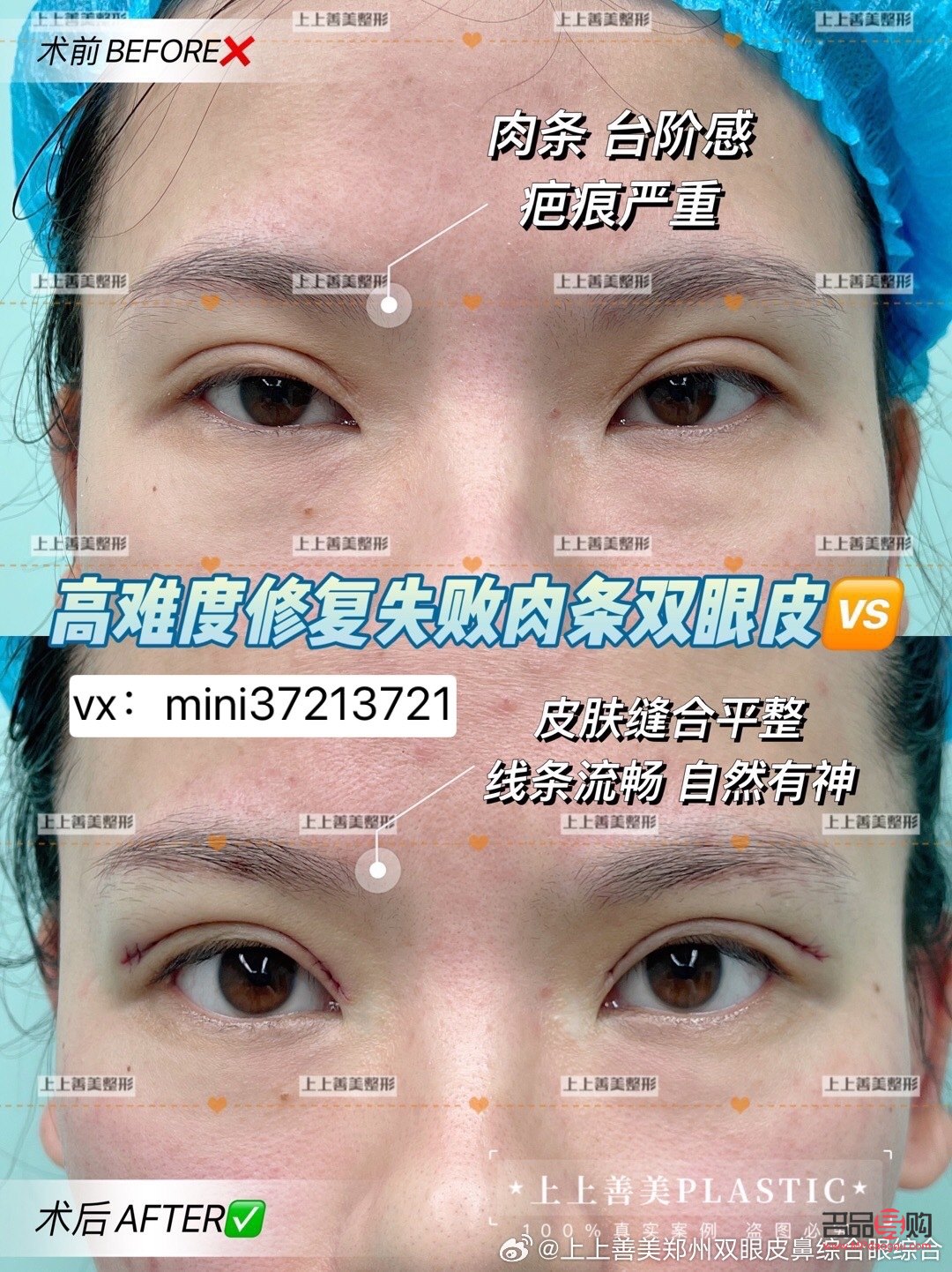 双眼皮肉条感怎么修复(双眼皮有肉条感怎么修复)