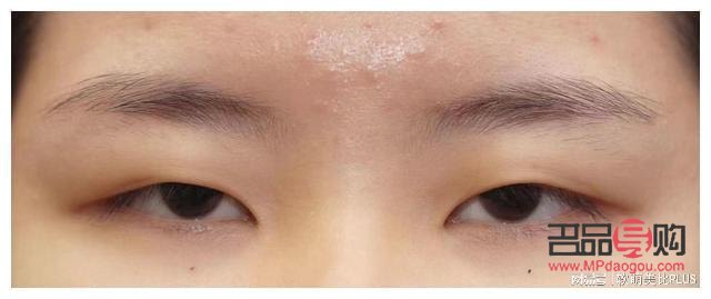 单眼皮眼睛下垂怎么办(单眼皮眼睛下垂怎么办图片)