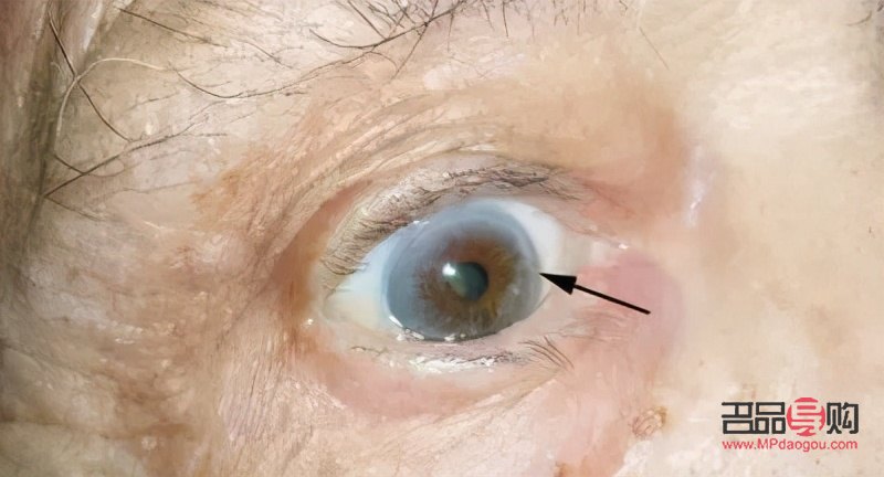 眼皮下垂怎么自然恢复(眼皮下垂怎么自然恢复小妙招)