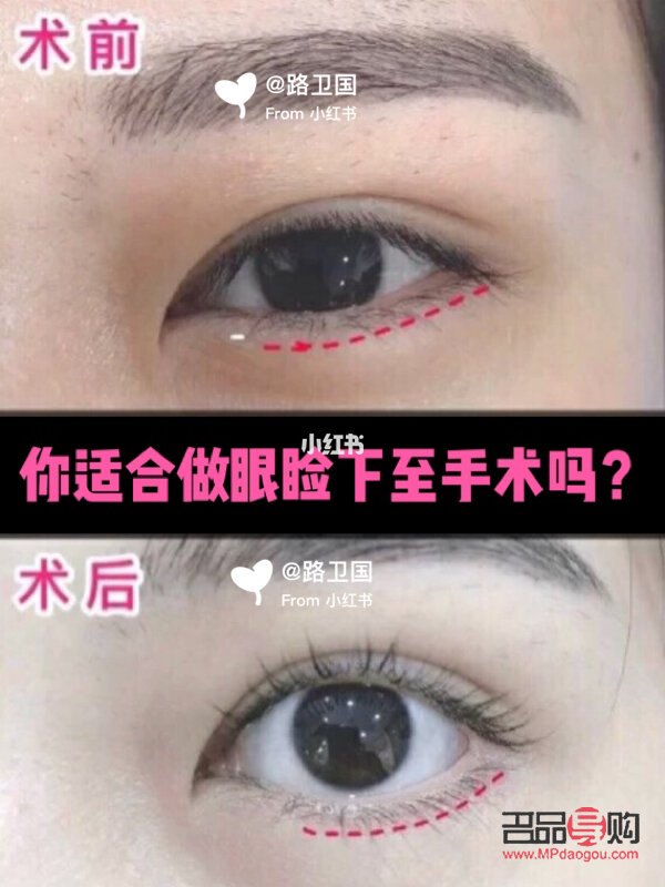 双眼皮下至有必要吗(双眼皮下至有必要做吗)