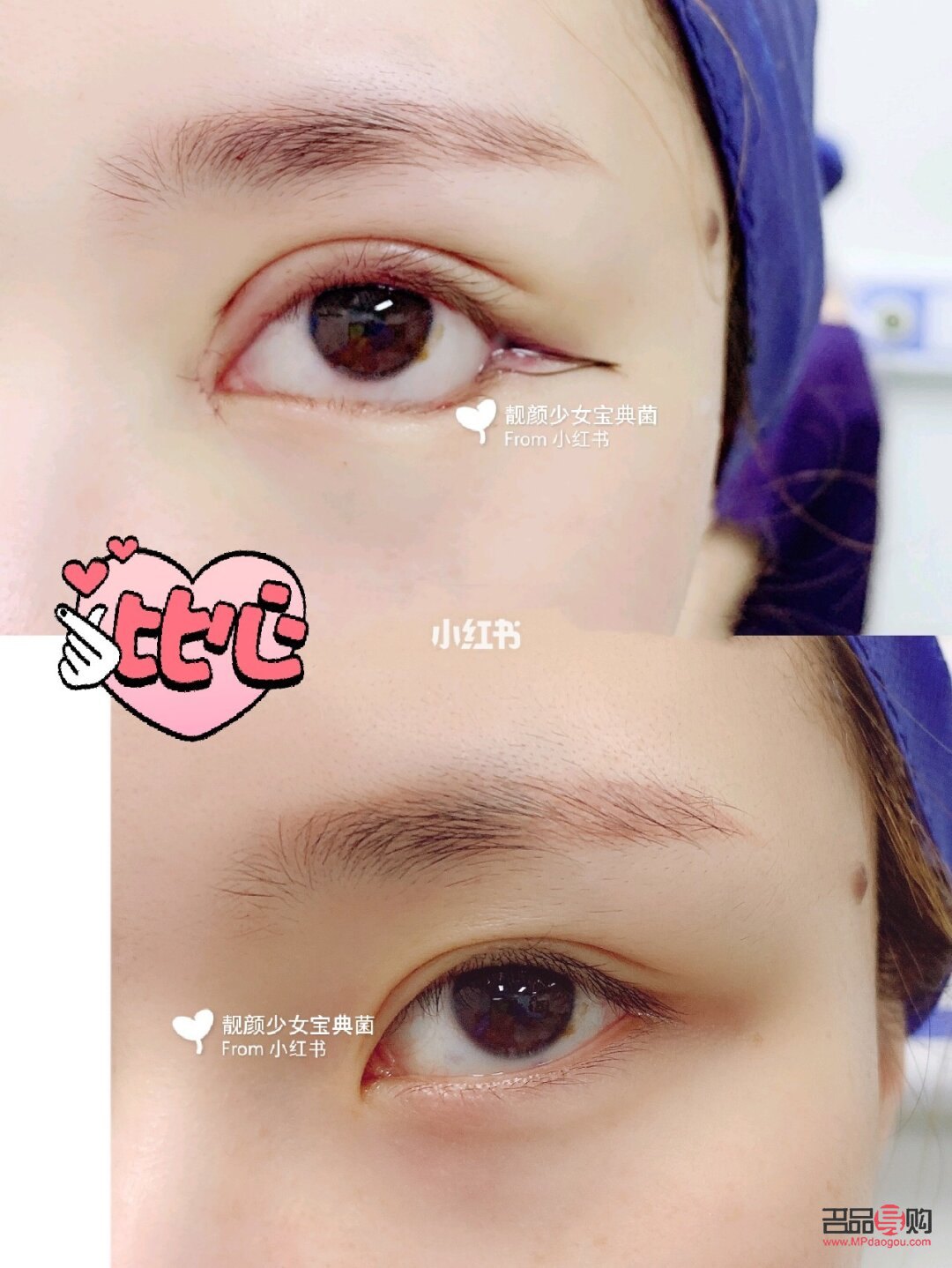 双眼皮下至有必要吗(双眼皮下至有必要做吗)