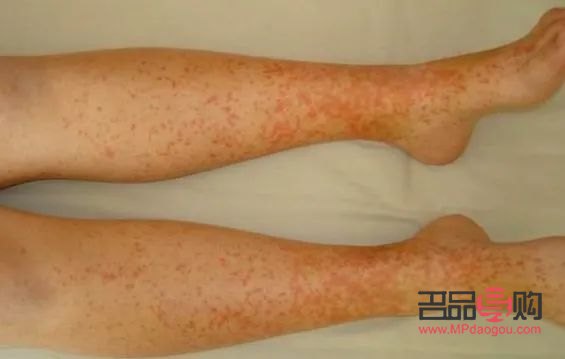 成人低烧怎么护理身体(成人低烧怎么护理身体呢)