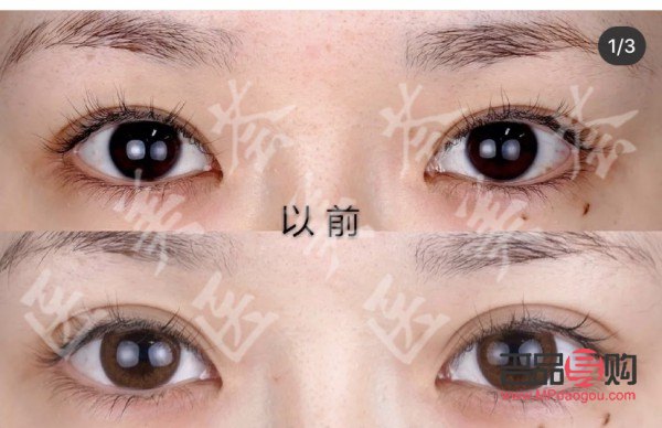 内双眼皮外双眼皮区别图片(内双眼皮外双眼皮区别图片女) 内双眼皮外双眼皮区别图片(内双眼皮外双眼皮区别图片女)