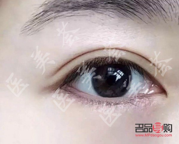 内双眼皮外双眼皮区别图片(内双眼皮外双眼皮区别图片女) 内双眼皮外双眼皮区别图片(内双眼皮外双眼皮区别图片女)