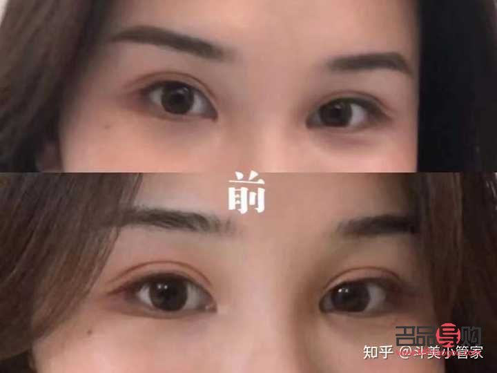 割双眼皮最好的是什么季节(割双眼皮哪个季节割恢复的最快)