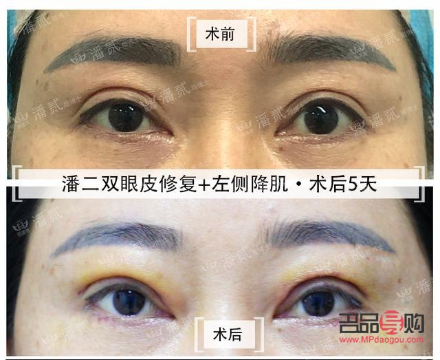 割双眼皮发黄说明快好了吗(割双眼皮发黄说明快好了吗图片)