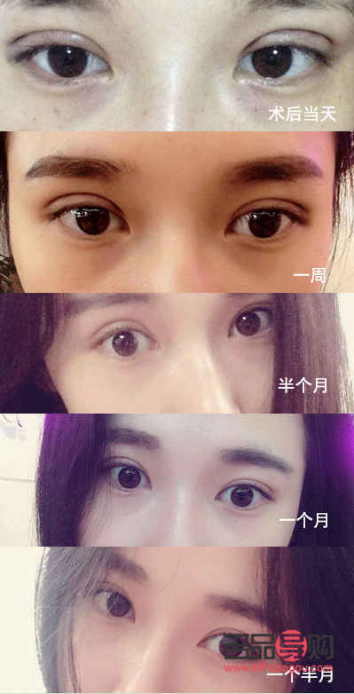 全切双眼皮1个月恢复图详解