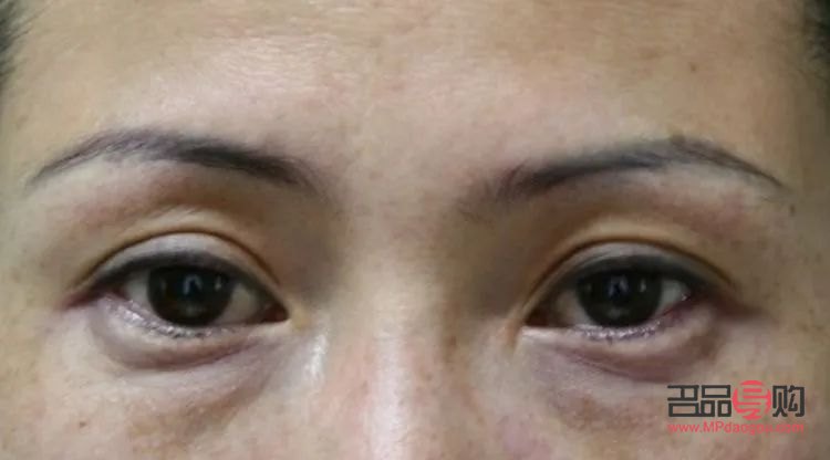 眼轮匝肌肥厚型眼袋怎么形成的(眼轮匝肌肥厚型眼袋怎么去除) 眼轮匝肌肥厚型眼袋怎么形成的(眼轮匝肌肥厚型眼袋怎么去除)