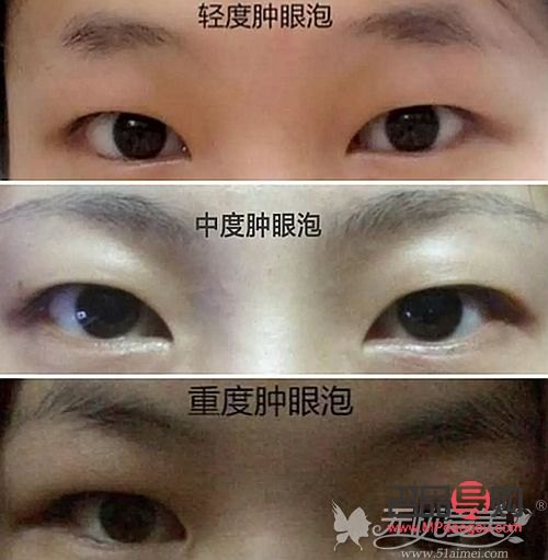 肿眼泡手术价格(肿眼泡手术价格是多少)