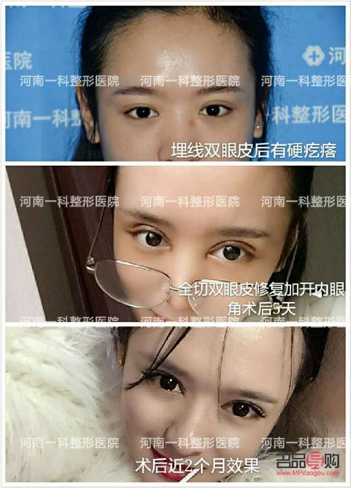 做个双眼皮多少价钱？了解双眼皮手术费用及考量因素