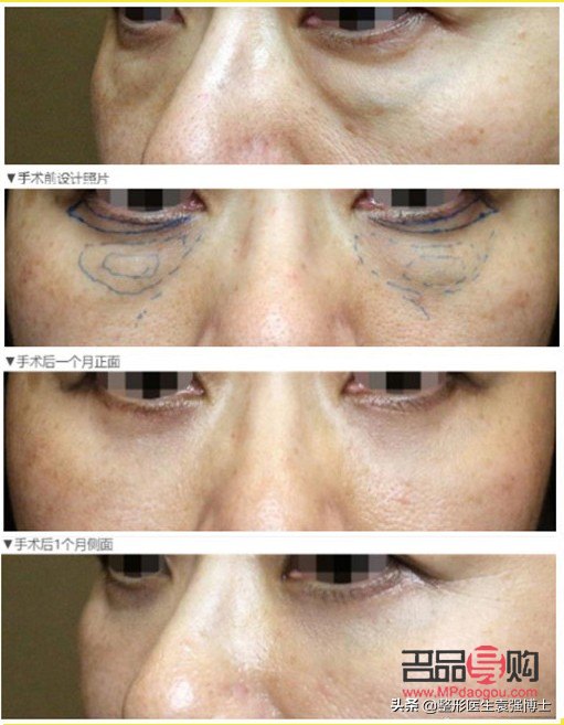 <h3>手术去眼袋，眼部健康会受影响吗？</h3>