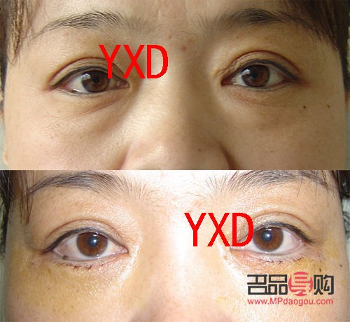 <h3>手术去眼袋，眼部健康会受影响吗？</h3>