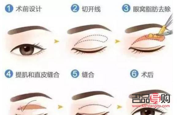 双眼皮松弛下垂最好解决方法(双眼皮松弛下垂最好解决方法做手术会难看吗)