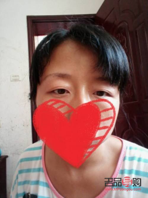 双眼皮松弛下垂最好解决方法(双眼皮松弛下垂最好解决方法做手术会难看吗)