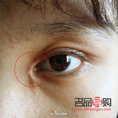 内眼角开太大图片(内眼角开大了会有什么问题)