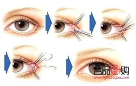 内眼角开太大图片(内眼角开大了会有什么问题)