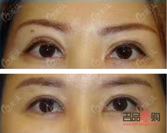 西安市做双眼皮哪家好(西安市做双眼皮哪家好一点)