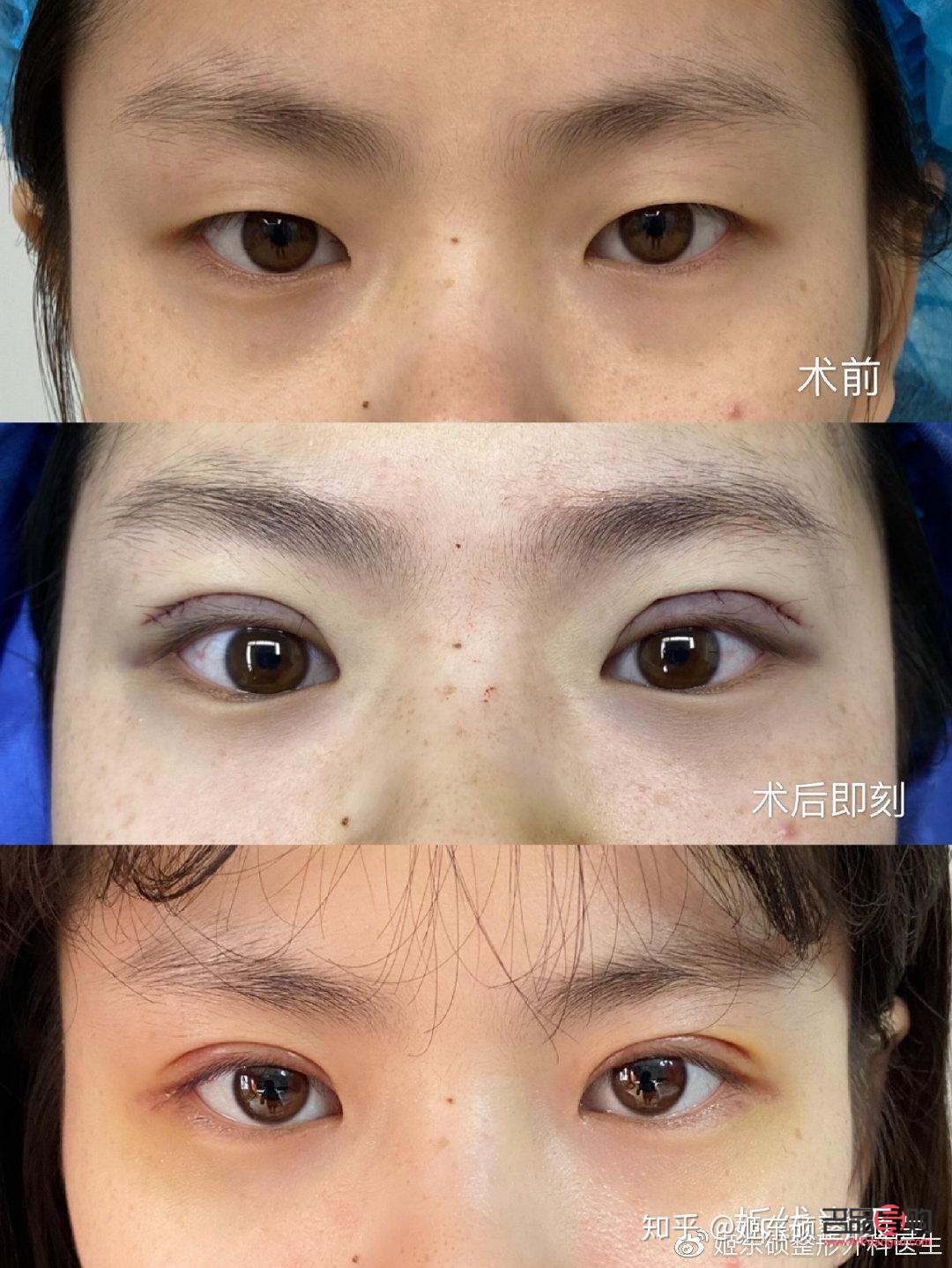 全切双眼皮会越来越窄吗(全切双眼皮会越来越窄吗?多久可以定型)