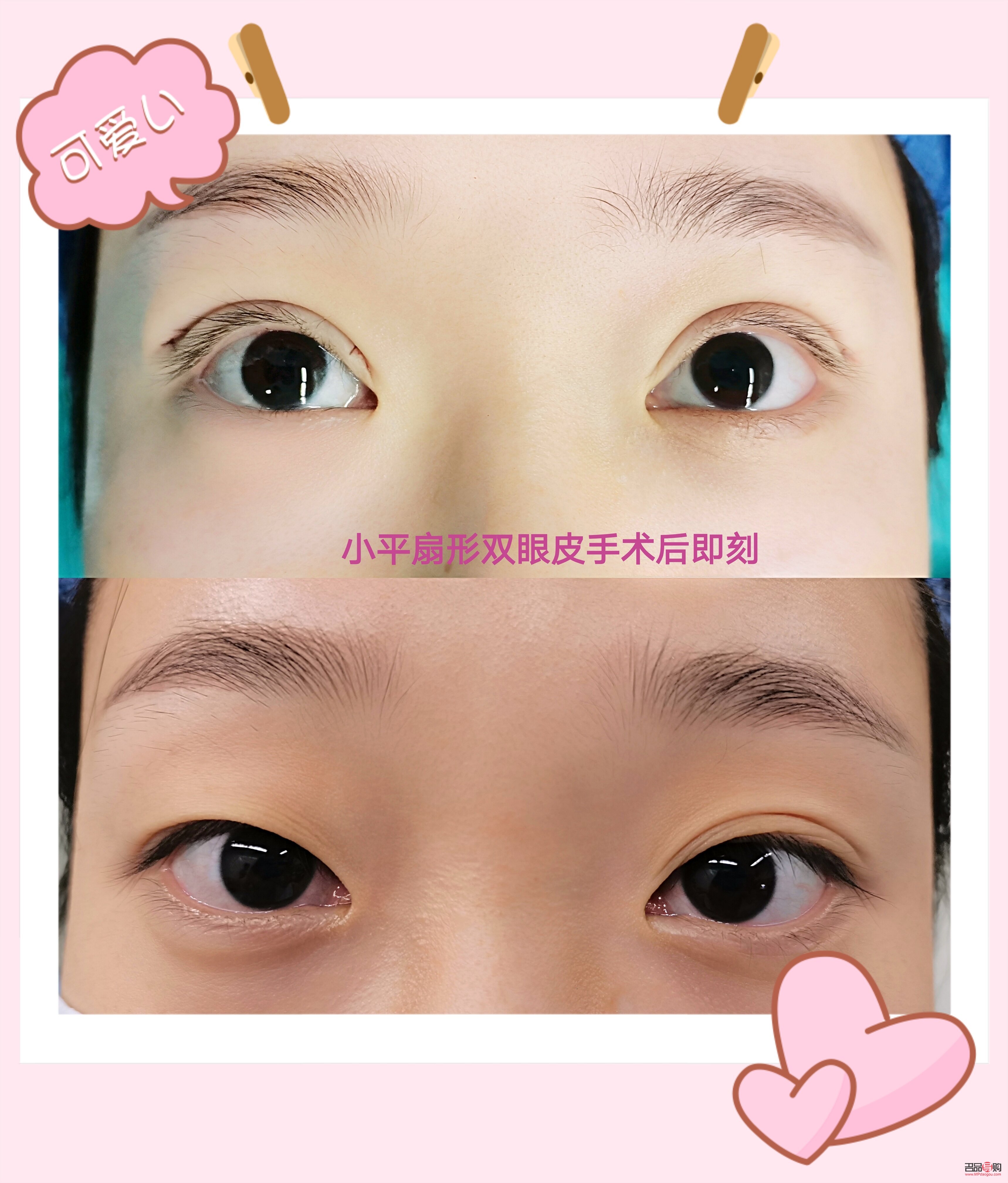 平扇双眼皮显年轻吗(平扇双眼皮显年轻吗女生)