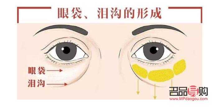 眼袋咋去掉(眼袋咋去掉视频)