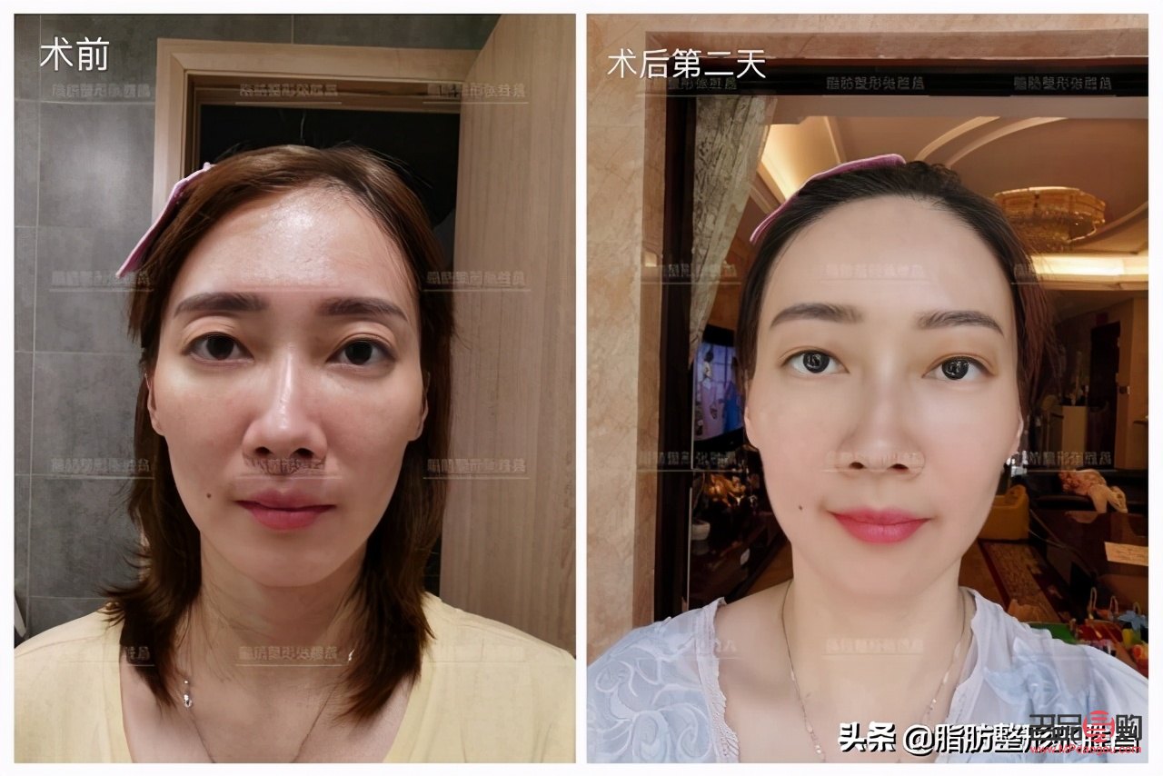 眼窝凹陷用什么填充最好(眼窝凹陷用什么填充最好多少钱)