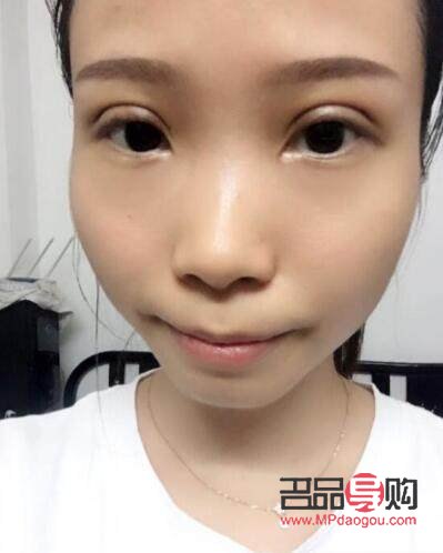 全切双眼皮手术的后遗症风险