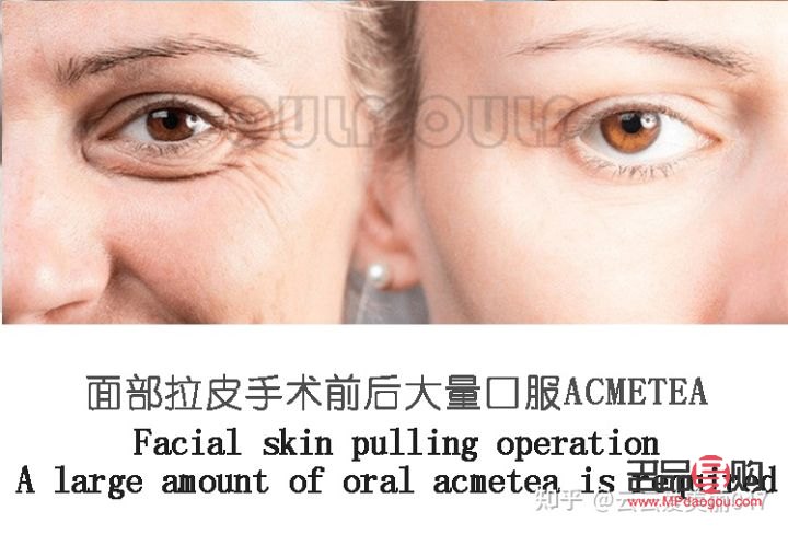 双眼皮提拉手术可以保持几年(双眼皮提拉手术可以保持几年吗)