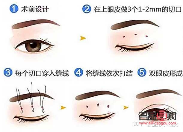 怎样让内双眼皮变成外双眼皮(怎样让内双眼皮变成外双眼皮呢)