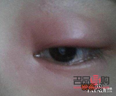 <h3>下眼袋浮肿原因及应对：蚊子包般的眼部问题解析</h3>