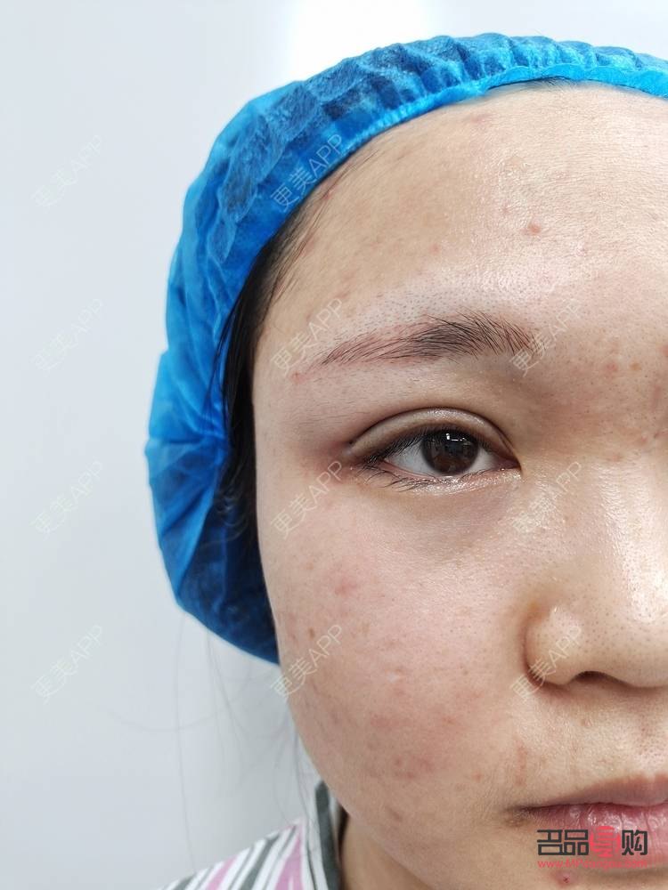 埋线与全切双眼皮：选择之美