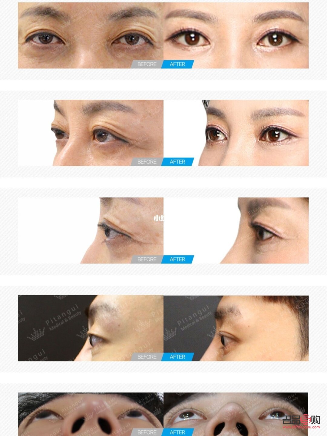 近视凸眼能否压回去？专业解析与改善建议