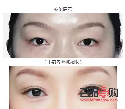 做什么样的双眼皮比较好(做什么样的双眼皮比较好看)