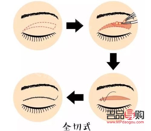 全切双眼皮示意图(全切双眼皮示意图全过程) 全切双眼皮示意图(全切双眼皮示意图全过程)