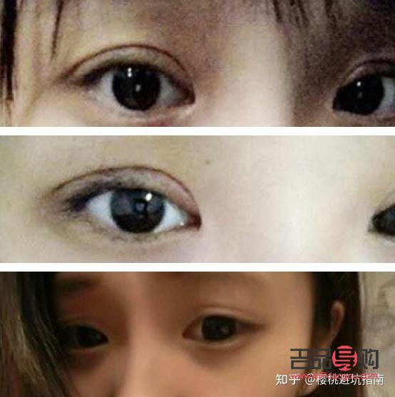 双眼皮图片类型(双眼皮图片类型大全)