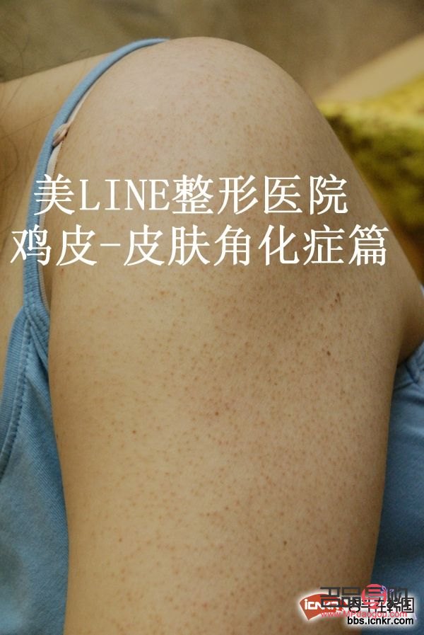 <h3>身体护理祛鸡皮效果探讨</h3>