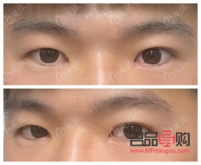 双眼皮7mm恢复后多宽图片男(双眼皮7mm恢复后多宽图片男生)